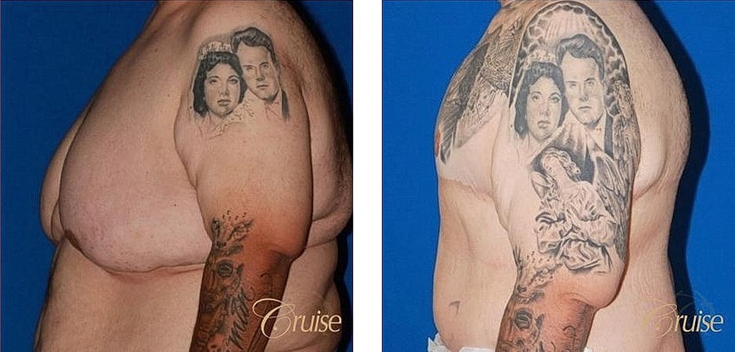 Tattoo transformation before and after procedure.