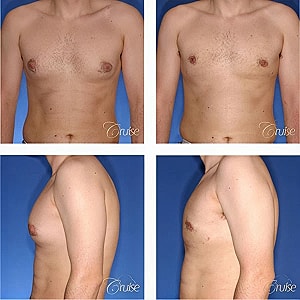 Before and after photos of male chest transformation.