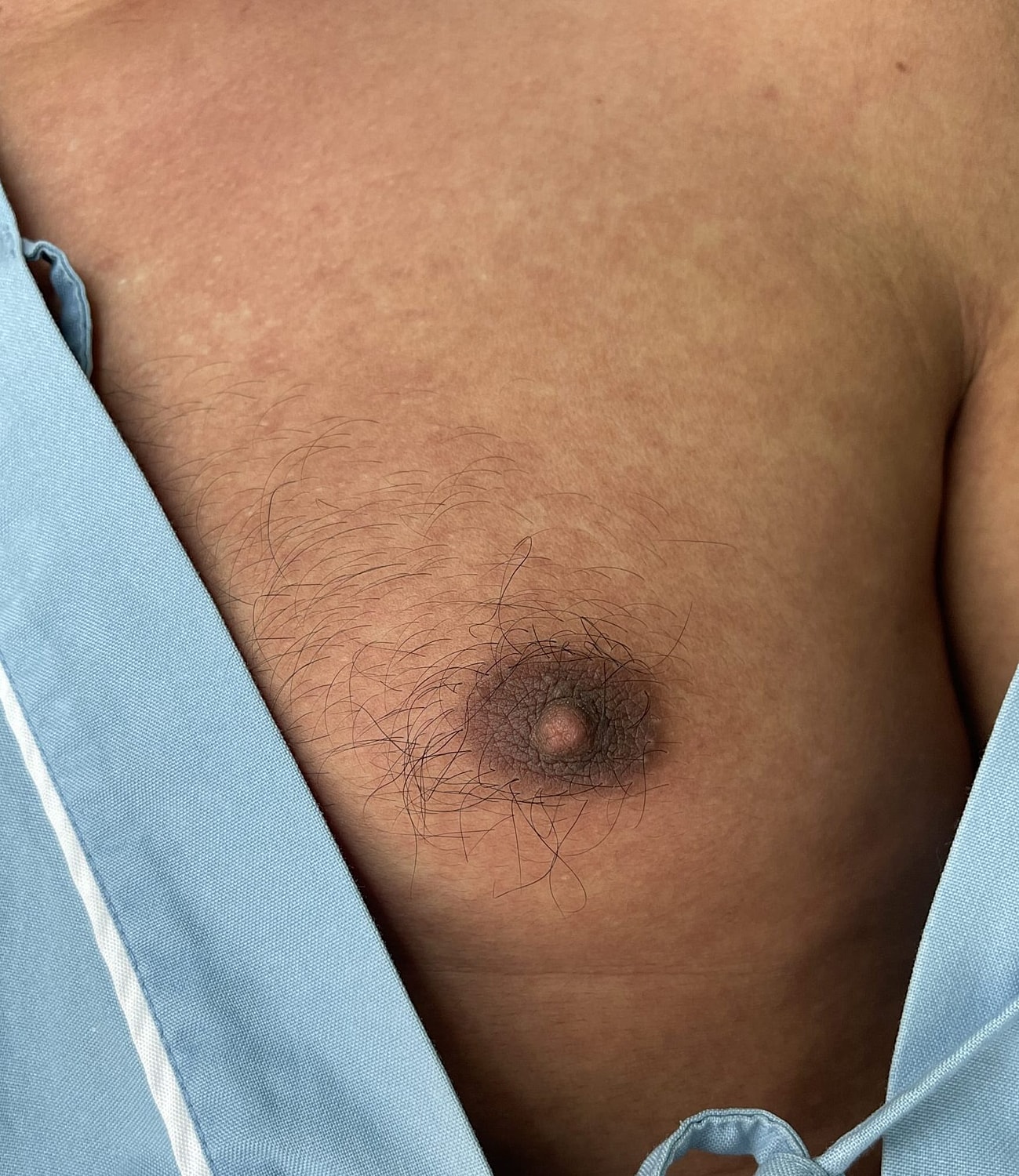 5 Common Gynecomastia Surgery Complications