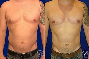 Answering Your Most Common Gynecomastia Questions