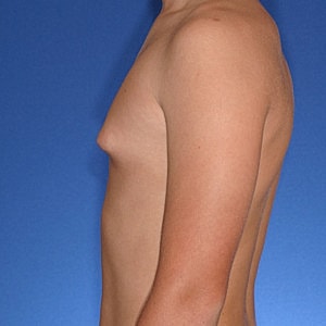 Gynecomastia in Teenage Boys