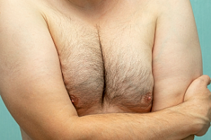 What Happens If Gynecomastia Isn’t Treated?