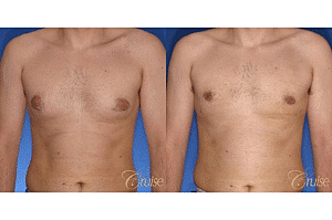 What You Should Know About Gynecomastia: Type 1