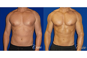 What You Should Know About Gynecomastia: Type 2