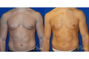 What You Should Know About Gynecomastia: Type 3