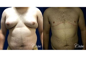 What You Should Know About Gynecomastia: Type 5