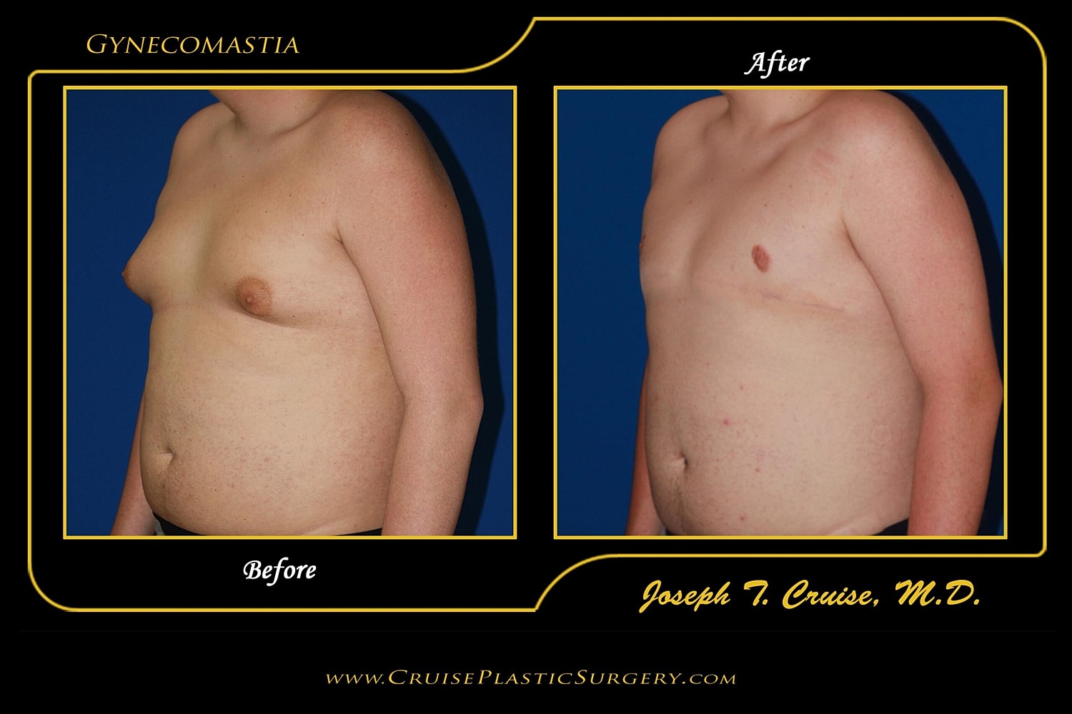 Men Suffering with Severe Gynecomastia Now Have Access to a Superior Surgical Option
