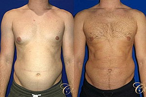 What You Need to Know Before Gynecomastia Surgery