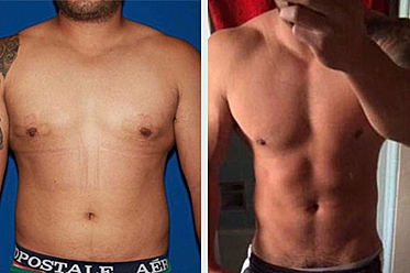 Tips to Prepare for Gynecomastia Surgery