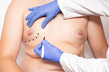 Which Type of Gynecomastia Do I Have?