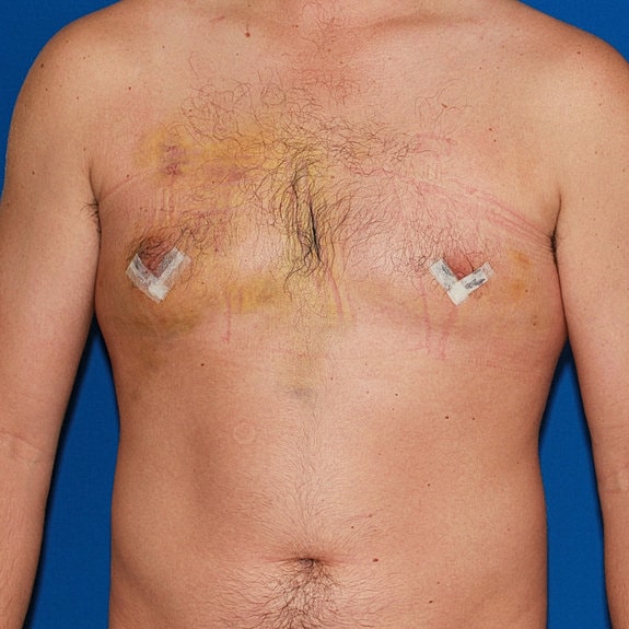 Post-surgical chest with healing incisions.