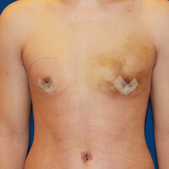 Post-surgery chest with healing incisions and bruising.