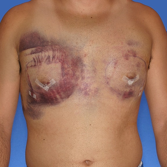 Chest with bruising and bandages post-surgery.