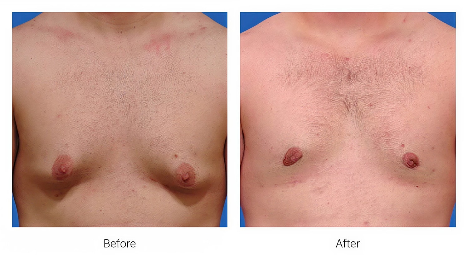 Before and after chest transformation comparison.