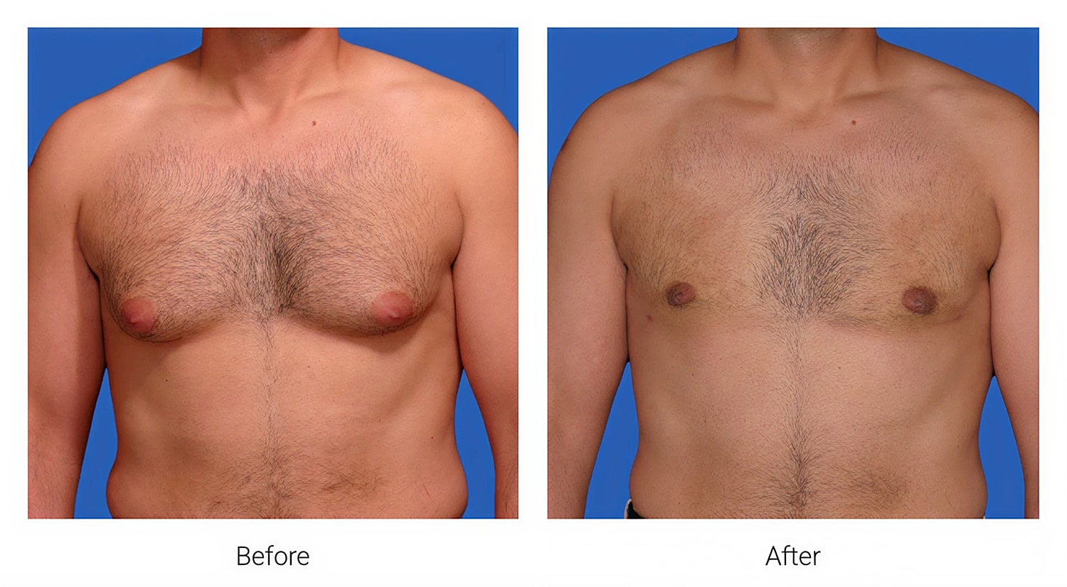 Chest transformation before and after procedure