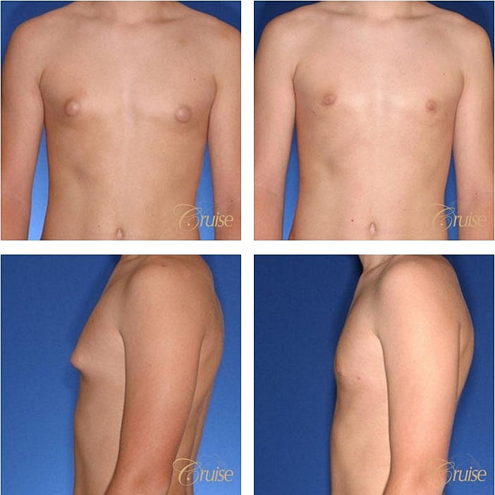 Before and after chest transformation images.