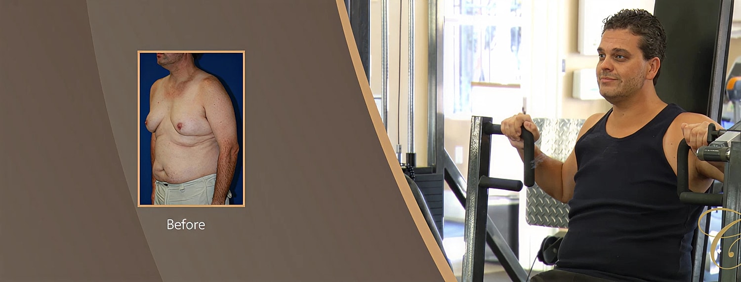 Male chest transformation before and after surgery.