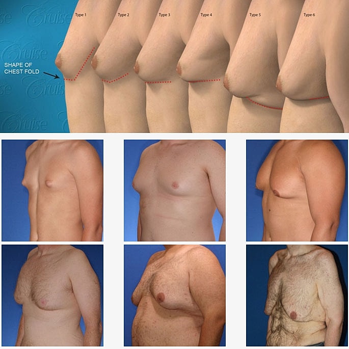 Chest fold shape types and male profiles comparison.