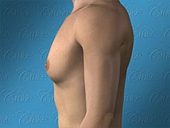 Human torso, front view, neutral background.