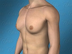 Human torso, front view, neutral background.