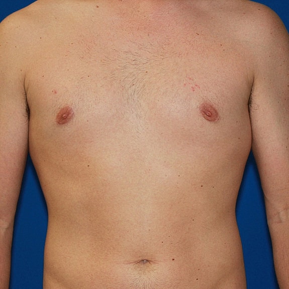 Chest with bandages and bruising after surgery.