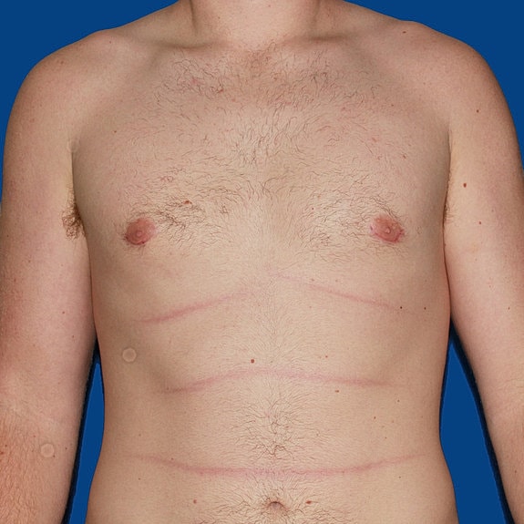 Chest with bandages and bruising after surgery.