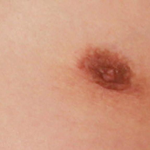 Chest with bandages and bruising after surgery.