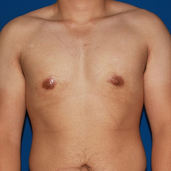 Chest with bandages and bruising after surgery.