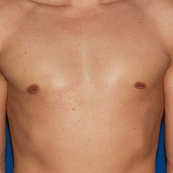 Chest with bandages and bruising after surgery.
