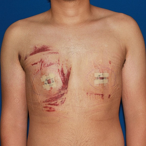 Chest with bandages and bruising after surgery.