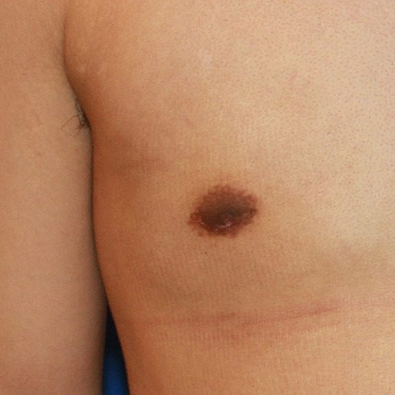 Chest with bandages and bruising after surgery.