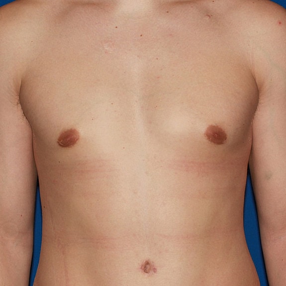 Chest with bandages and bruising after surgery.