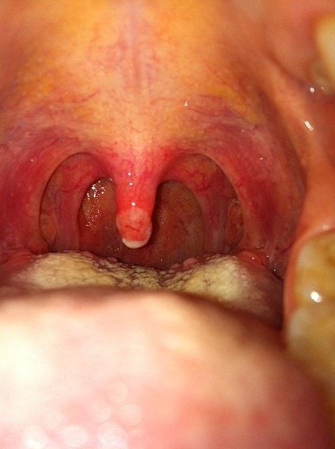 View of the throat and uvula interior.