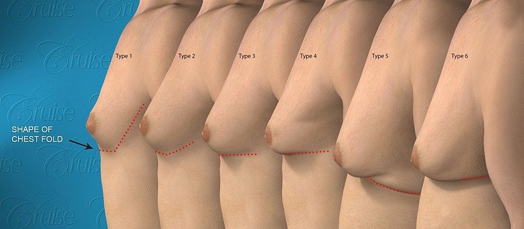Chest fold shape variation types comparison image.