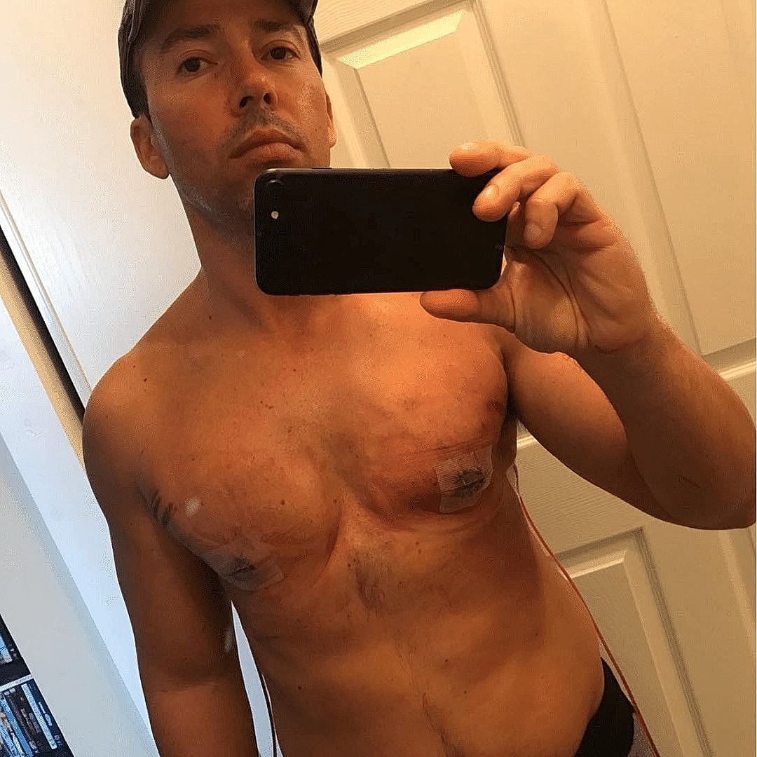 Man taking a selfie, showing chest bandages.