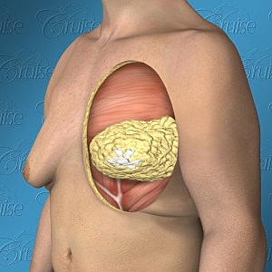 Male anatomical illustration highlighting chest musculature.