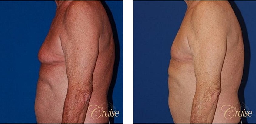 Before and after body transformation comparison.