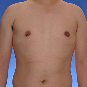 Bare chest of a young male subject