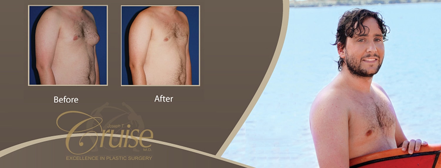 Male chest transformation before and after surgery.