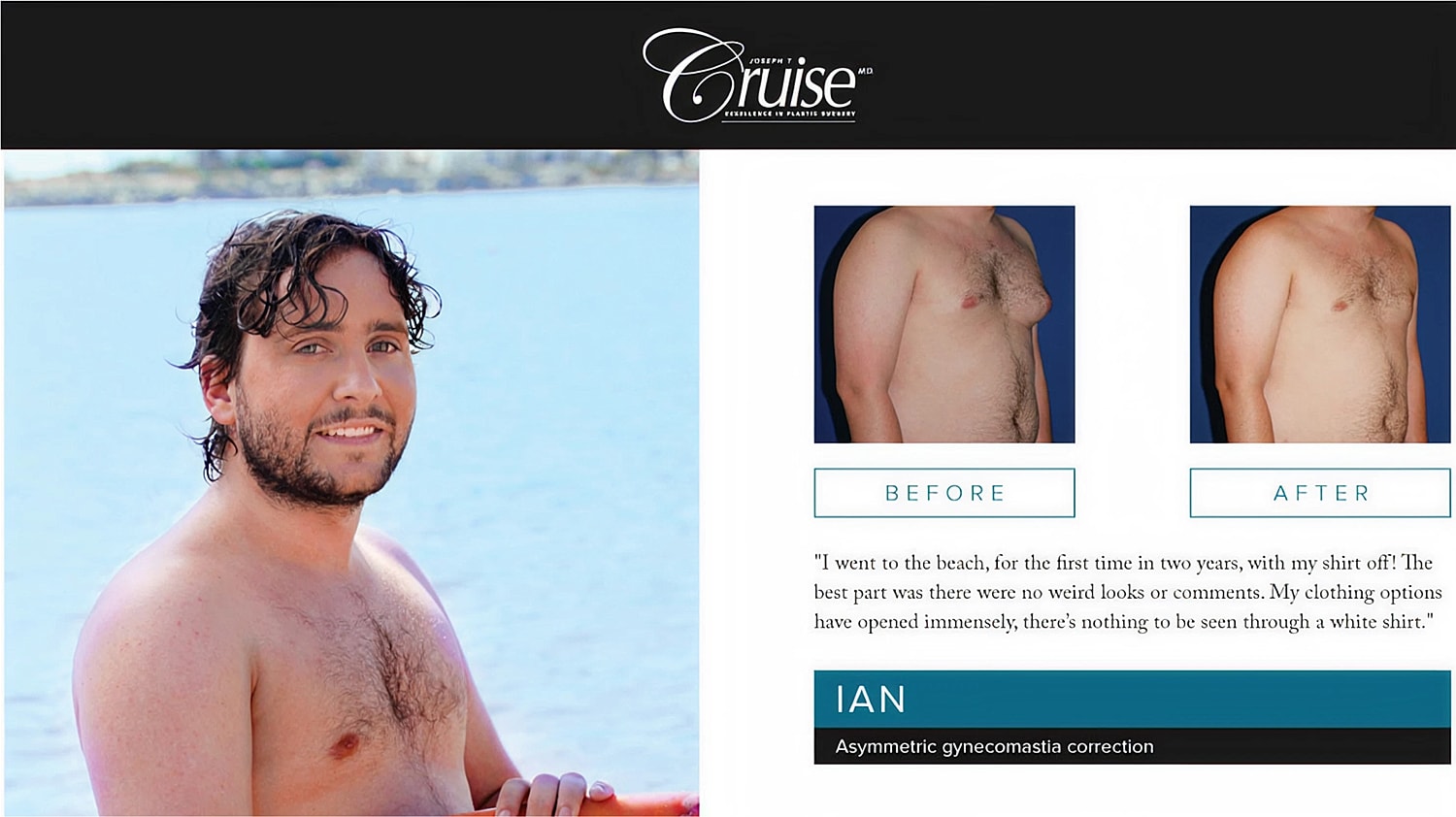 Man's gynecomastia correction before and after photos.