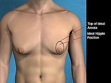 Chest anatomy with nipple position indicators.