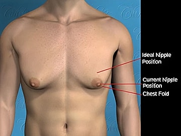 Chest anatomy with nipple position indicators.