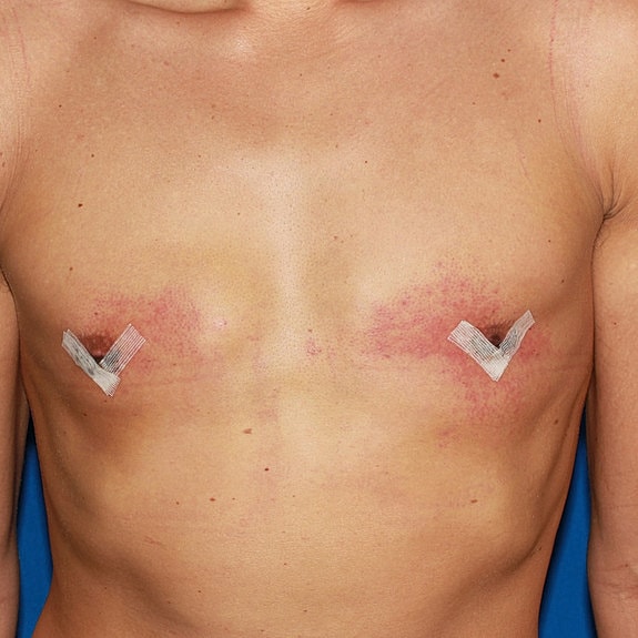 Post-surgical chest with healing tape markings.