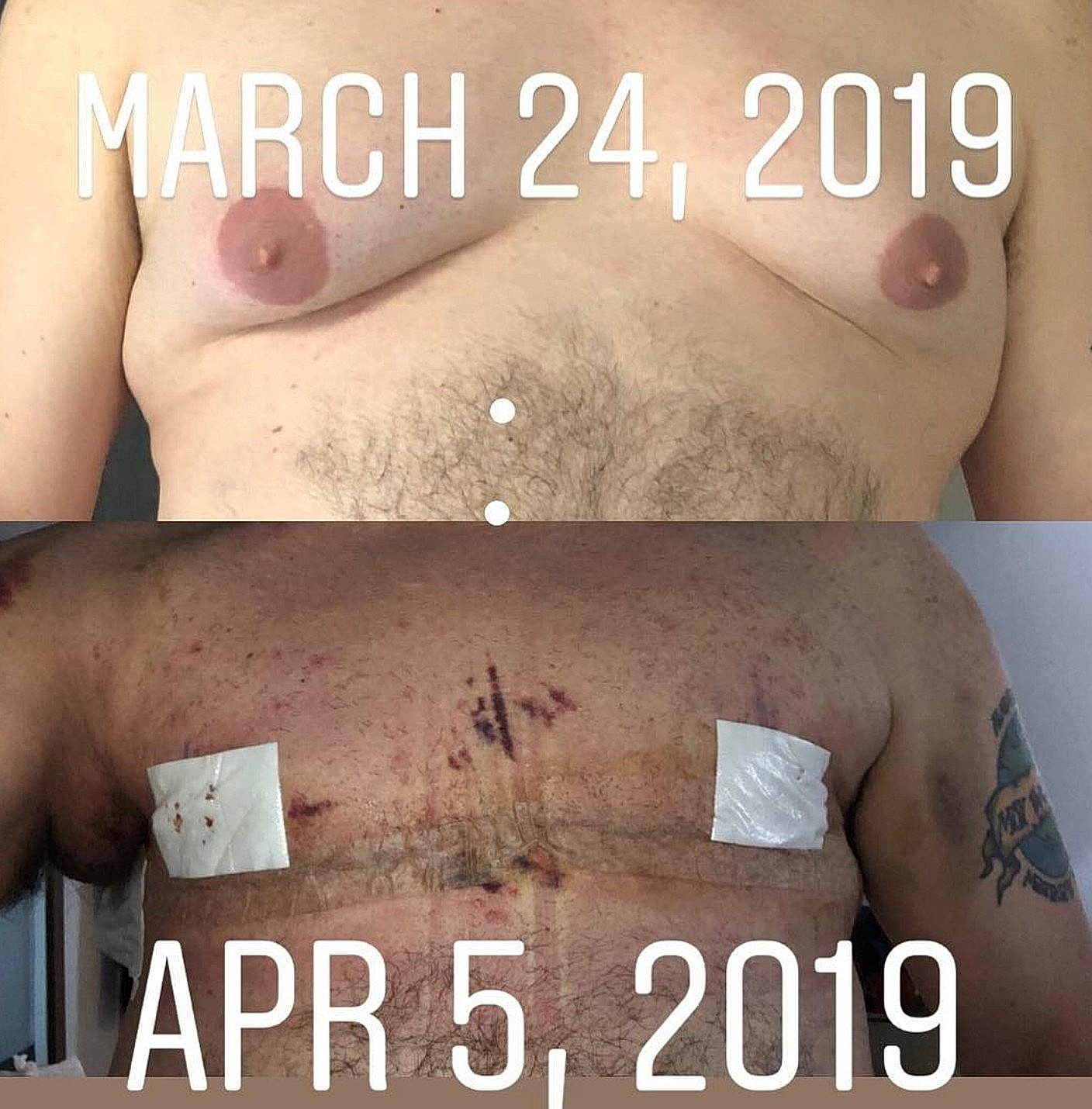 Before and after surgery photos, March to April.