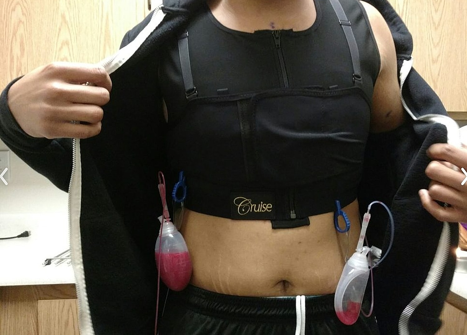 Person wearing a post-surgery compression garment.