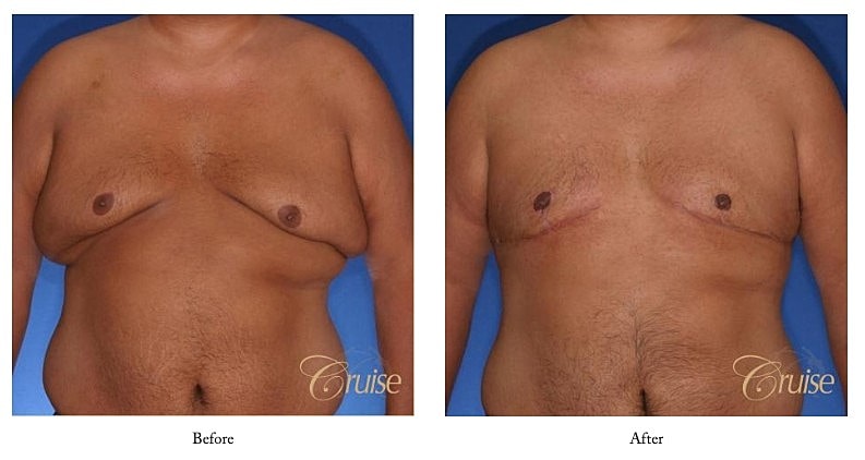 Man's chest, before and after surgery comparison.