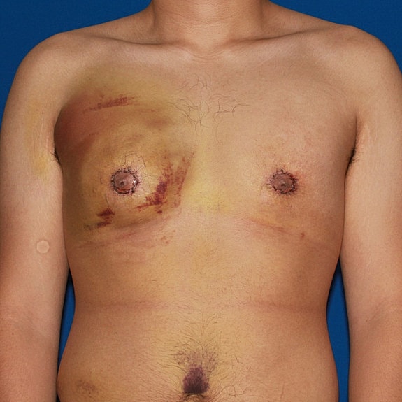 Chest with healing post-surgical bruising and scars.