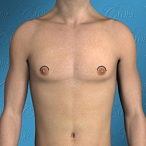 Illustration of male torso with marked areas.