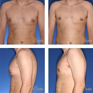 Male torso before and after surgery images