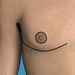 Anatomical image highlighting a male nipple.